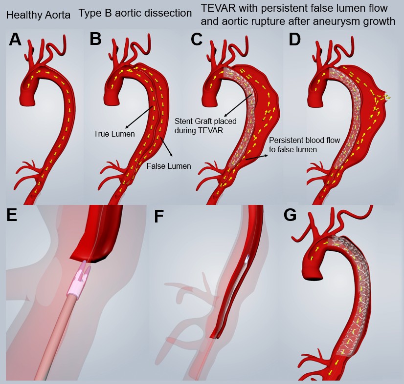 Seven-panel schematic showing a healthy aorta, Type B dissection with true and false lumens, TEVAR with persistent false lumen flow, aneurysmal expansion and rupture, catheter advanced over two guidewires, longitudinal transection of the septum, and the remodeled aorta after septotomy and TEVAR.