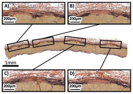 Longitudinal Verhoeff–Van Gieson stained histology section of a human artery with four magnified insets showing breaks in the external elastic lamina.
